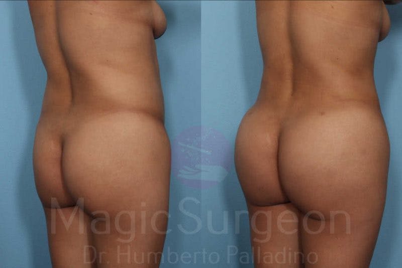Brazilian Butt Lift Before & After Gallery - Patient 133182287 - Image 5