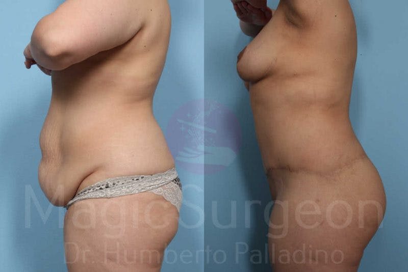 Body Contouring Before & After Gallery - Patient 133182289 - Image 3
