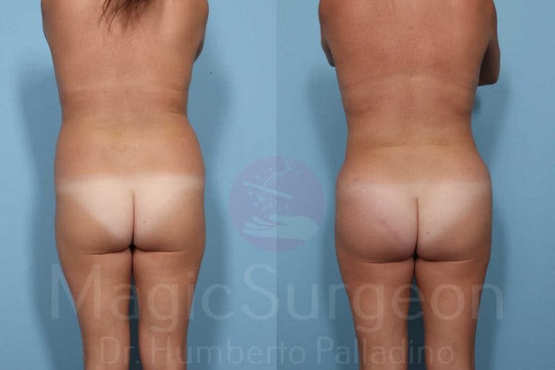 Brazilian Butt Lift Before & After Gallery - Patient 133182288 - Image 1