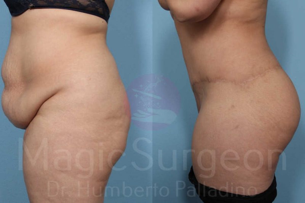 Body Contouring Before & After Gallery - Patient 133182289 - Image 4