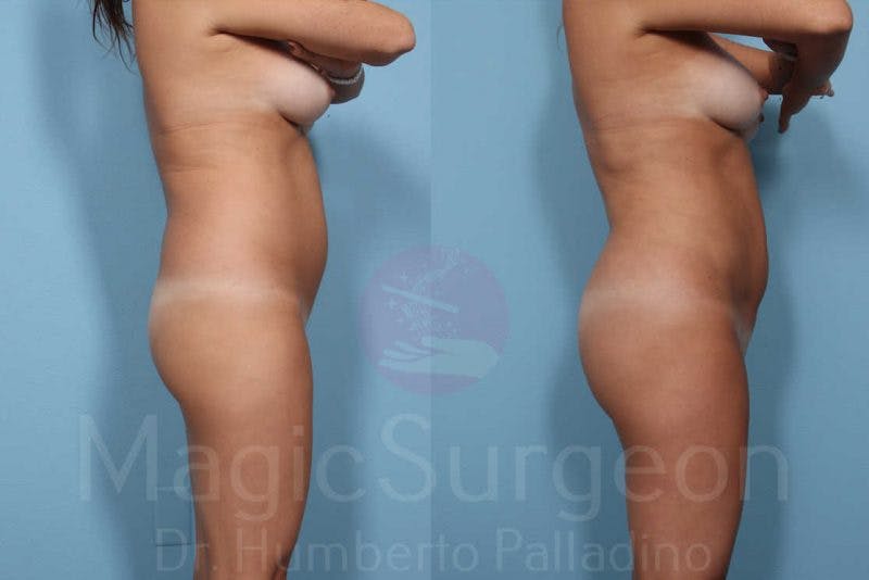 Brazilian Butt Lift Before & After Gallery - Patient 133182288 - Image 2