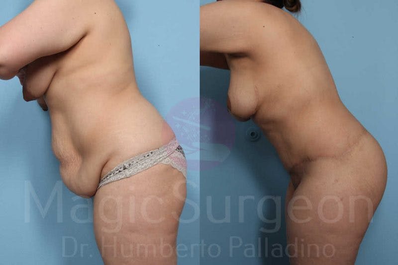 Body Contouring Before & After Gallery - Patient 133182289 - Image 6