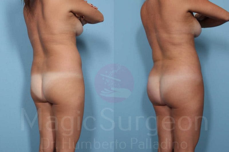 Brazilian Butt Lift Before & After Gallery - Patient 133182288 - Image 3