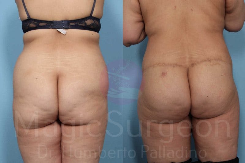 Body Contouring Before & After Gallery - Patient 133182289 - Image 7