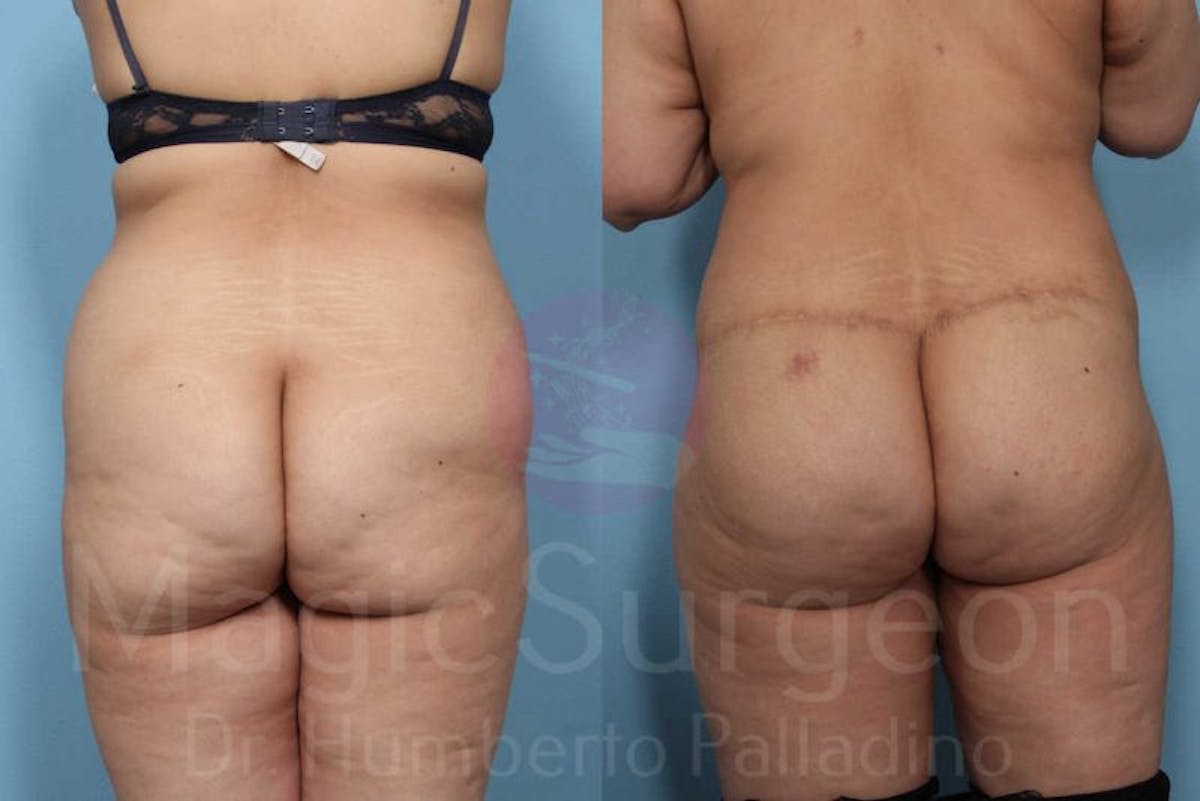 Body Contouring Before & After Gallery - Patient 133182289 - Image 7