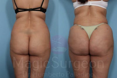 Brazilian Butt Lift Before & After Gallery - Patient 133182290 - Image 1