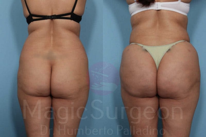 Brazilian Butt Lift Before & After Gallery - Patient 133182290 - Image 1