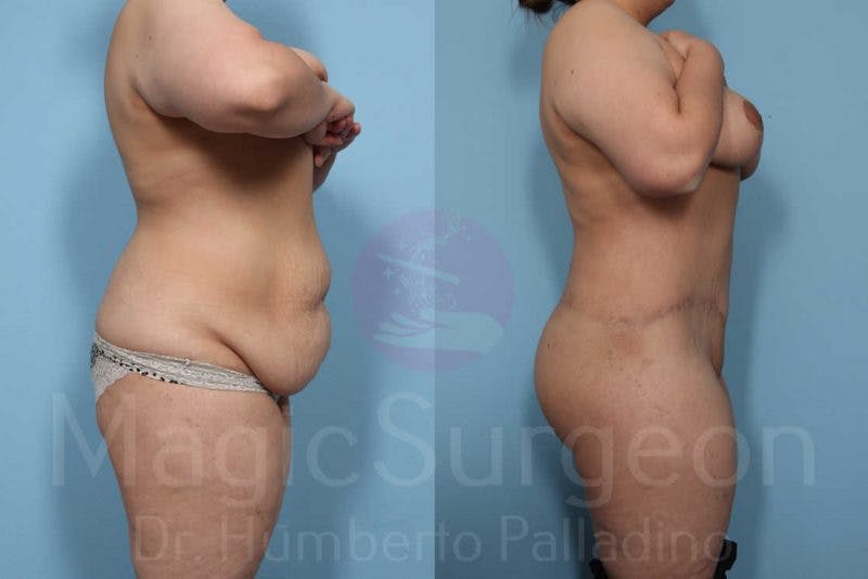 Body Contouring Before & After Gallery - Patient 133182289 - Image 8