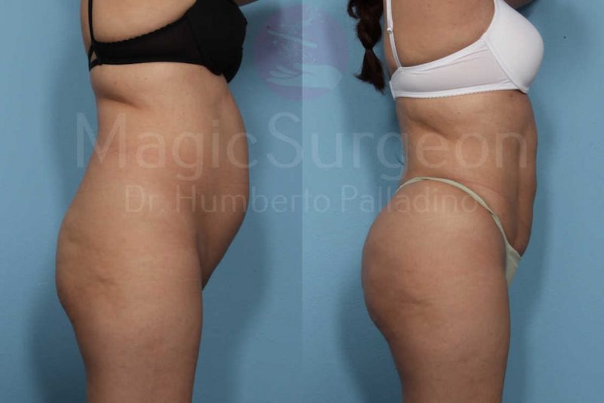 Brazilian Butt Lift Before & After Gallery - Patient 133182290 - Image 2