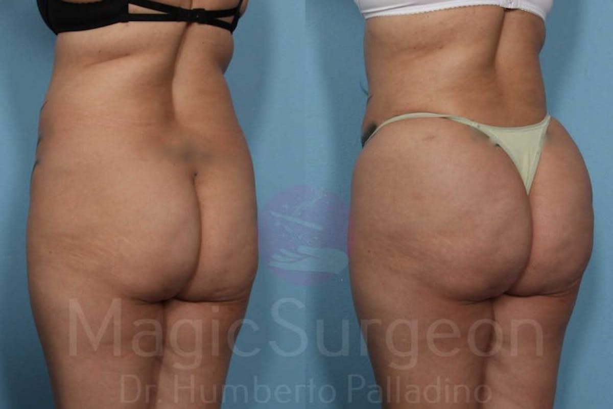 Brazilian Butt Lift Before & After Gallery - Patient 133182290 - Image 3