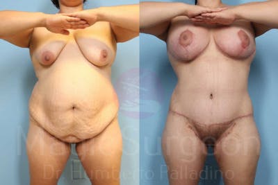 Body Contouring Before & After Gallery - Patient 133182292 - Image 1