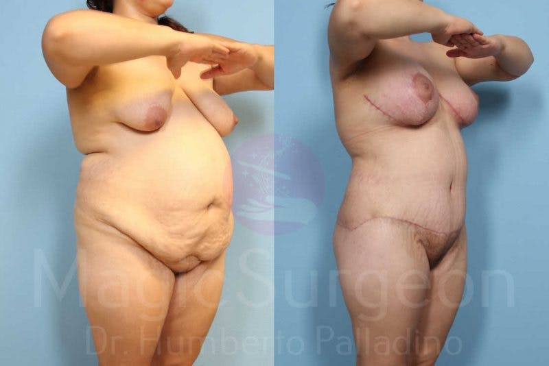 Body Contouring Before & After Gallery - Patient 133182292 - Image 2