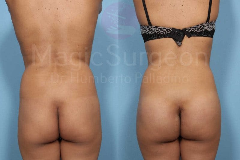 Butt Implants Before & After Gallery - Patient 133182291 - Image 1