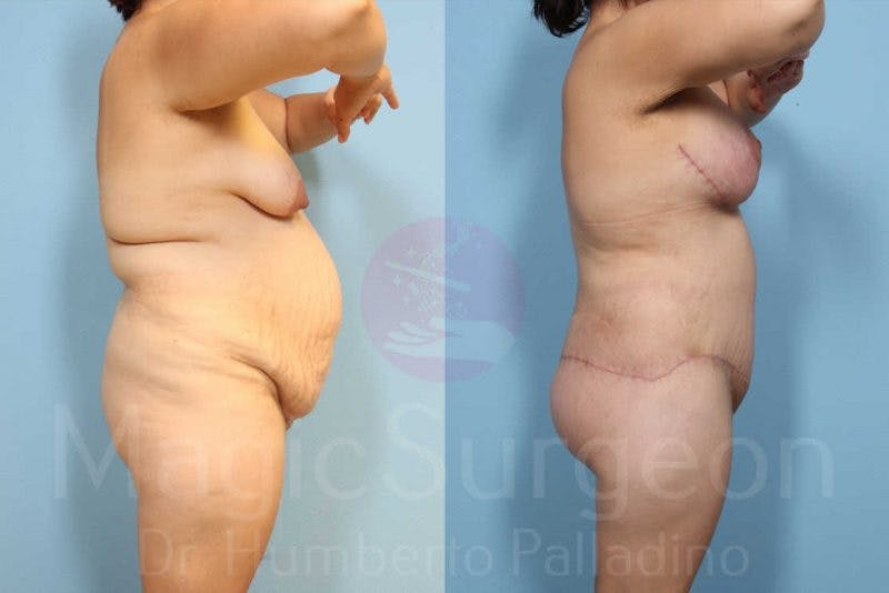 Body Contouring Before & After Gallery - Patient 133182292 - Image 3