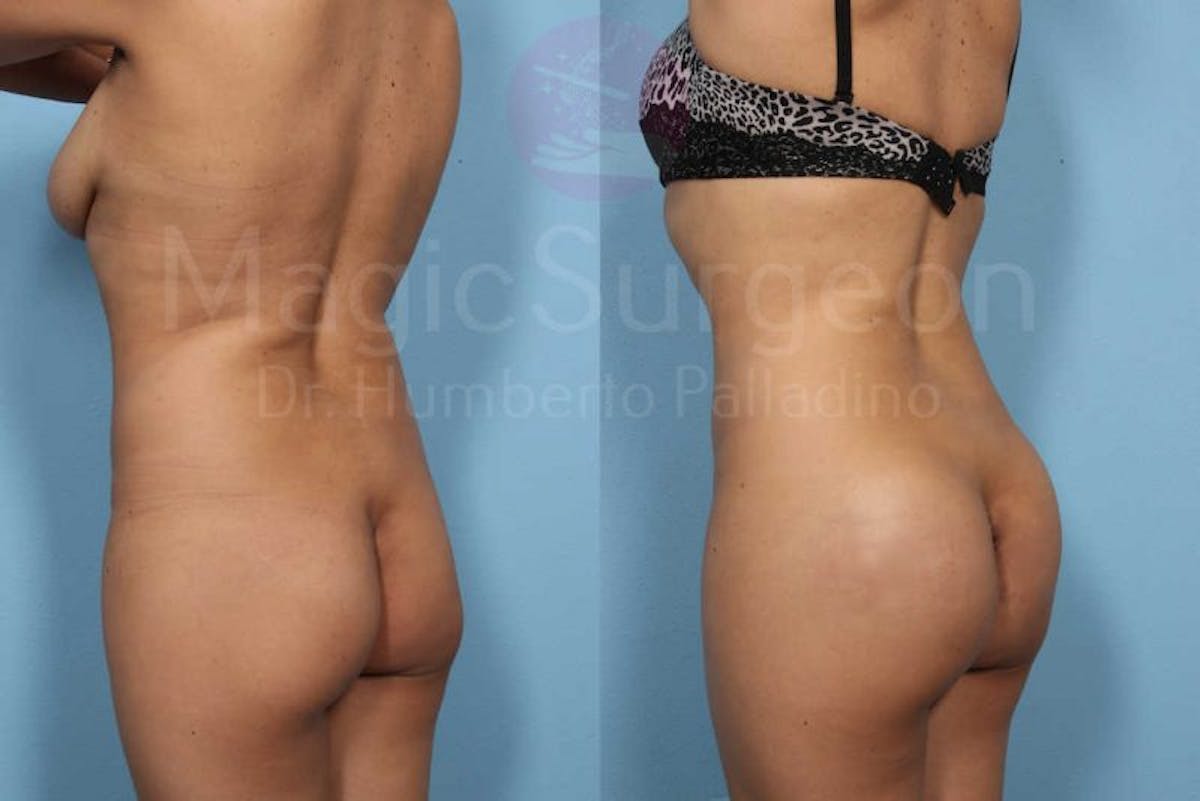 Butt Implants Before & After Gallery - Patient 133182291 - Image 2