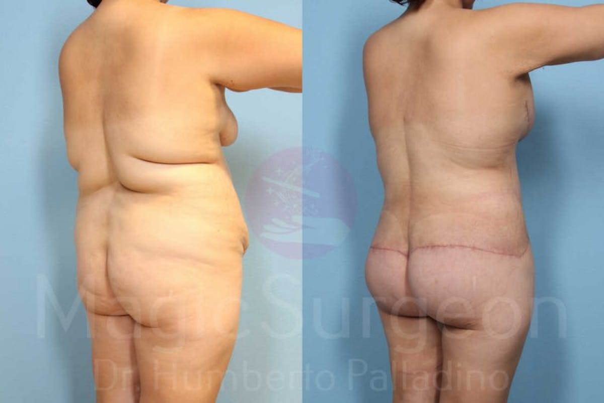 Body Contouring Before & After Gallery - Patient 133182292 - Image 4