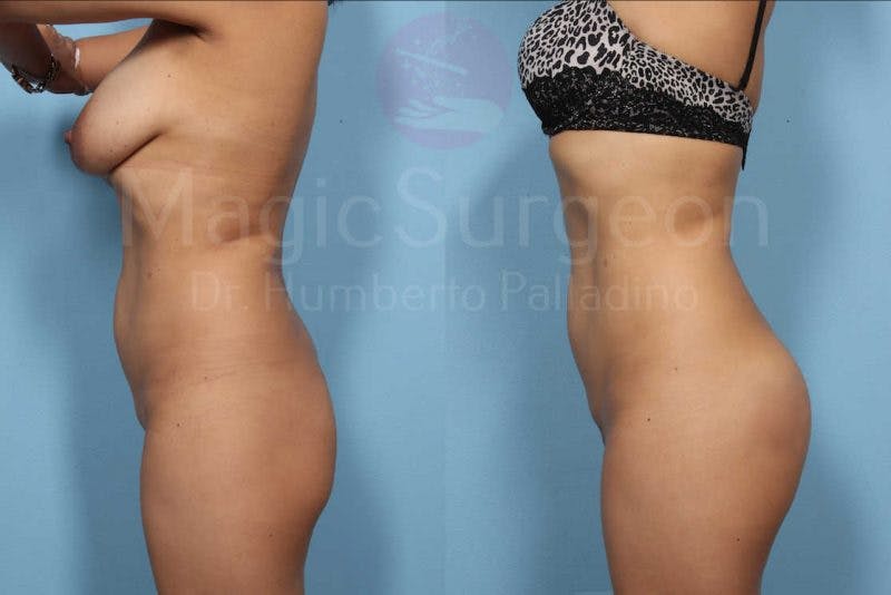 Butt Implants Before & After Gallery - Patient 133182291 - Image 3