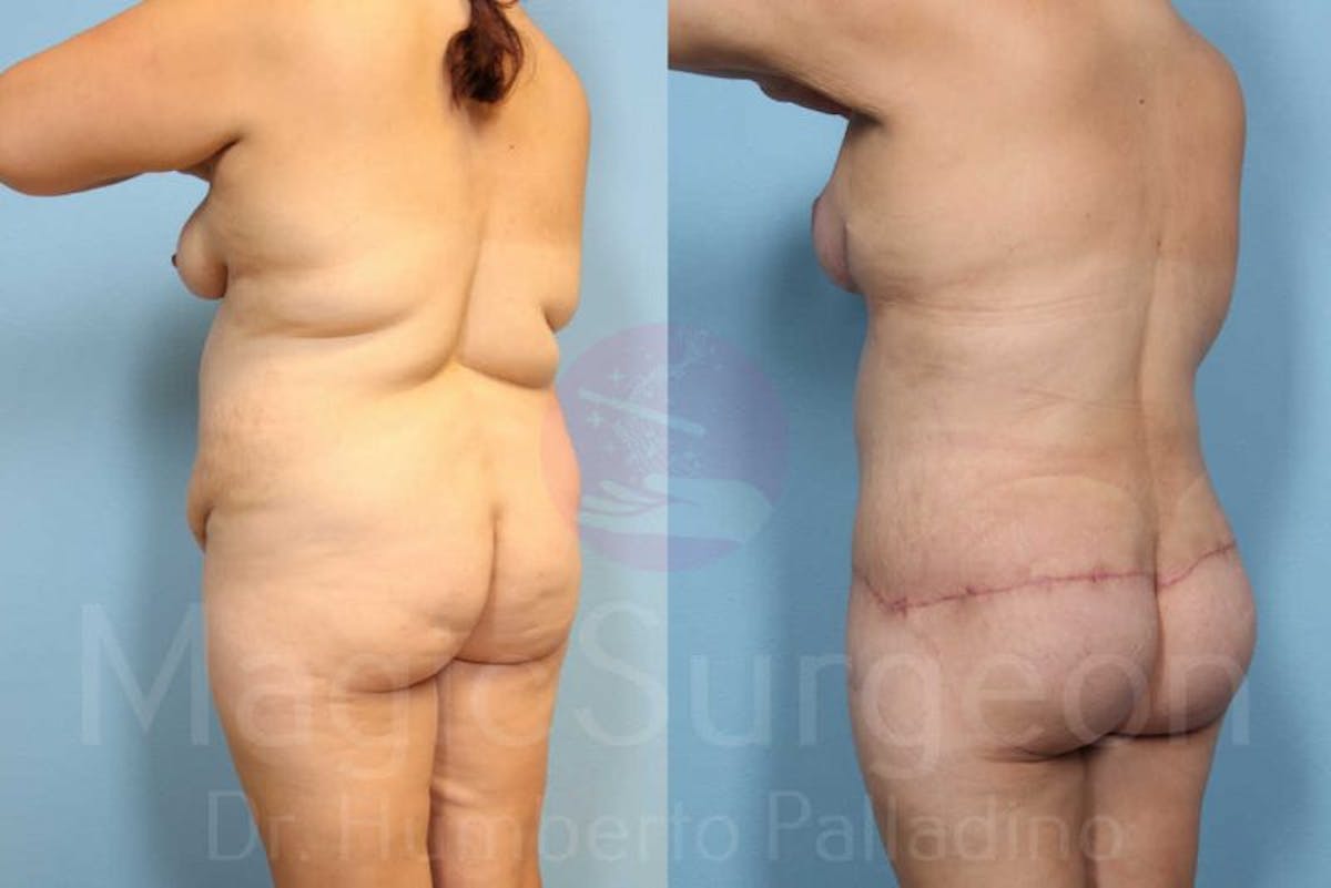 Body Contouring Before & After Gallery - Patient 133182292 - Image 6