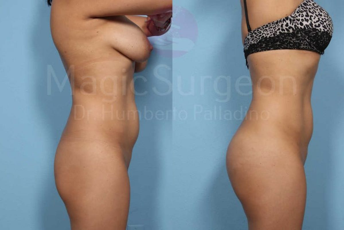 Butt Implants Before & After Gallery - Patient 133182291 - Image 5
