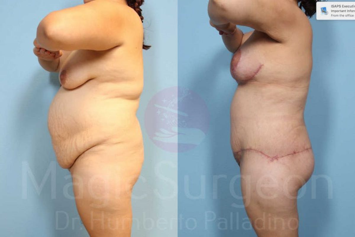 Body Contouring Before & After Gallery - Patient 133182292 - Image 7
