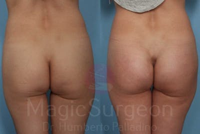 Butt Implants Before & After Gallery - Patient 133182293 - Image 1