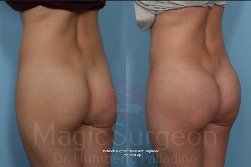 Butt Implants Before & After Gallery - Patient 133182293 - Image 2