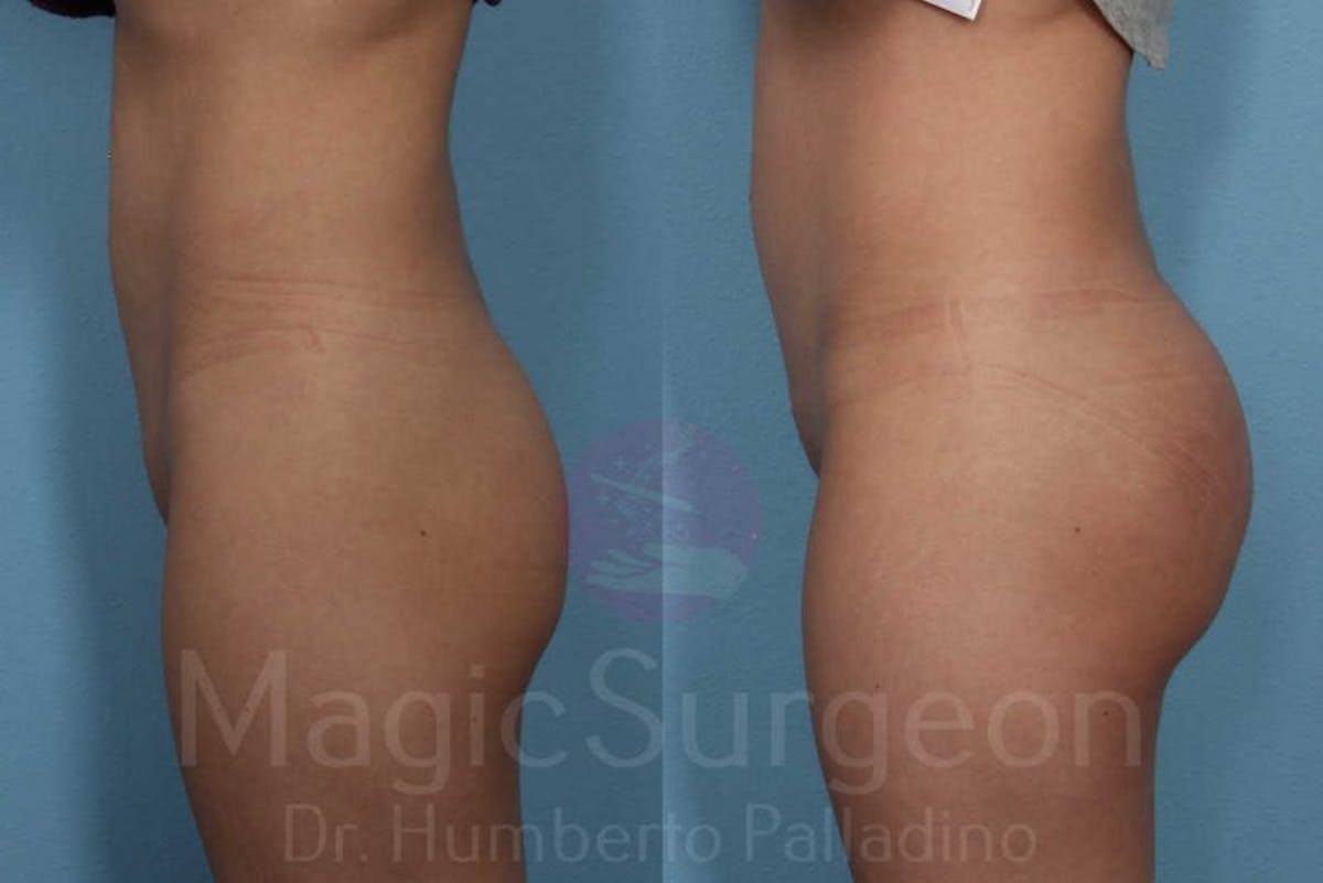 Butt Implants Before & After Gallery - Patient 133182293 - Image 3