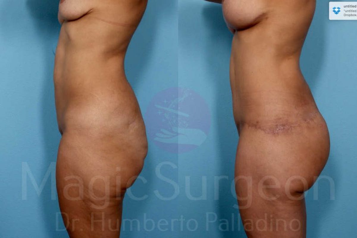 Body Contouring Before & After Gallery - Patient 133182294 - Image 3