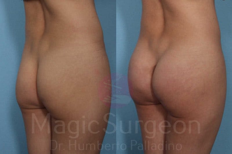 Butt Implants Before & After Gallery - Patient 133182293 - Image 4
