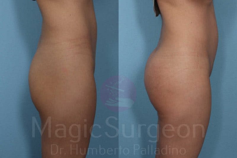 Butt Implants Before & After Gallery - Patient 133182293 - Image 5