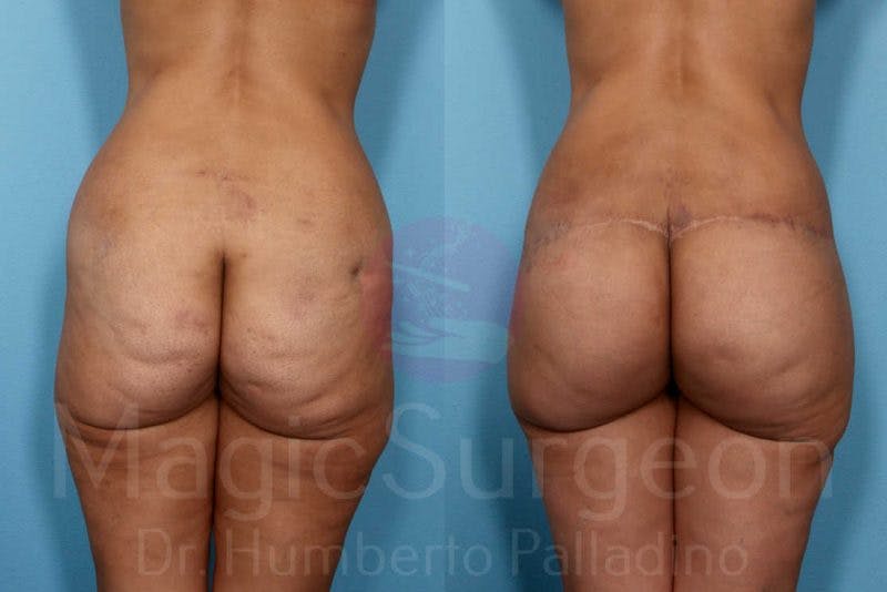 Body Contouring Before & After Gallery - Patient 133182294 - Image 5