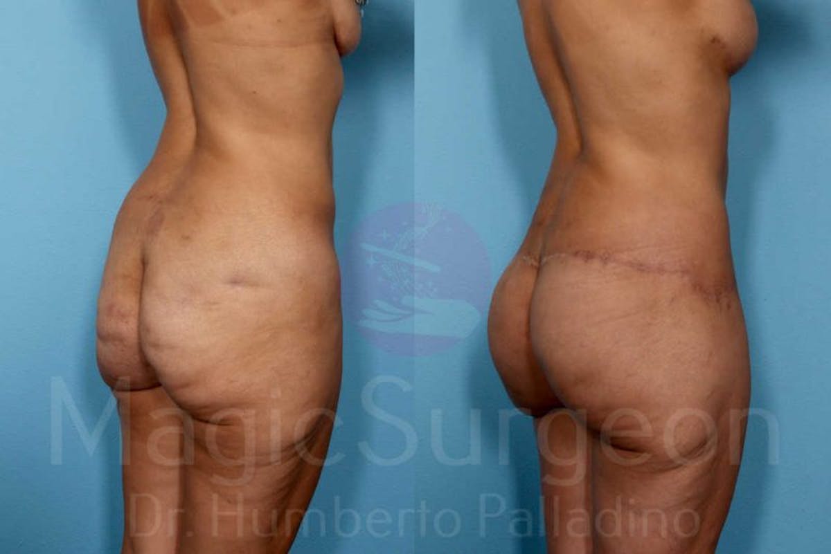 Body Contouring Before & After Gallery - Patient 133182294 - Image 6