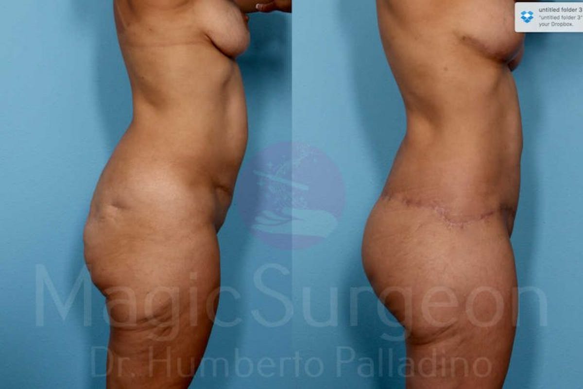 Body Contouring Before & After Gallery - Patient 133182294 - Image 7