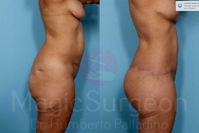 Body Contouring Before & After Gallery - Patient 133182294 - Image 7