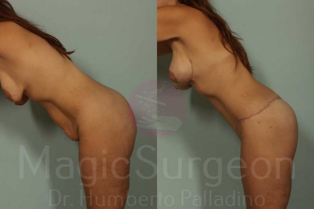 Body Contouring Before & After Gallery - Patient 133182300 - Image 4