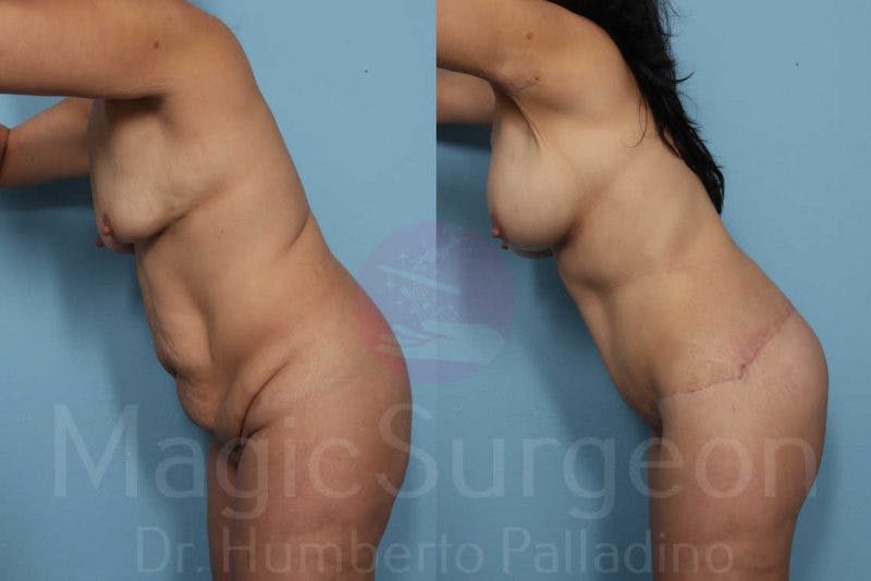 Body Contouring Before & After Gallery - Patient 133182301 - Image 4