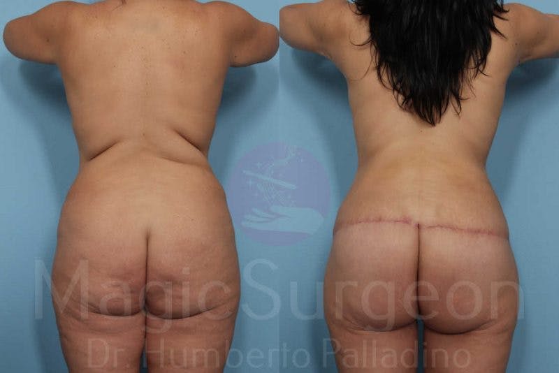 Body Contouring Before & After Gallery - Patient 133182301 - Image 5