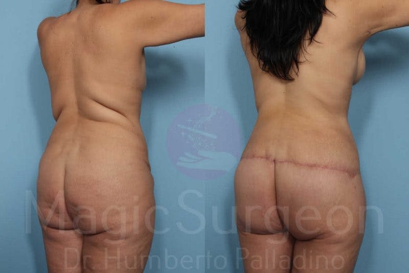 Body Contouring Before & After Gallery - Patient 133182301 - Image 6