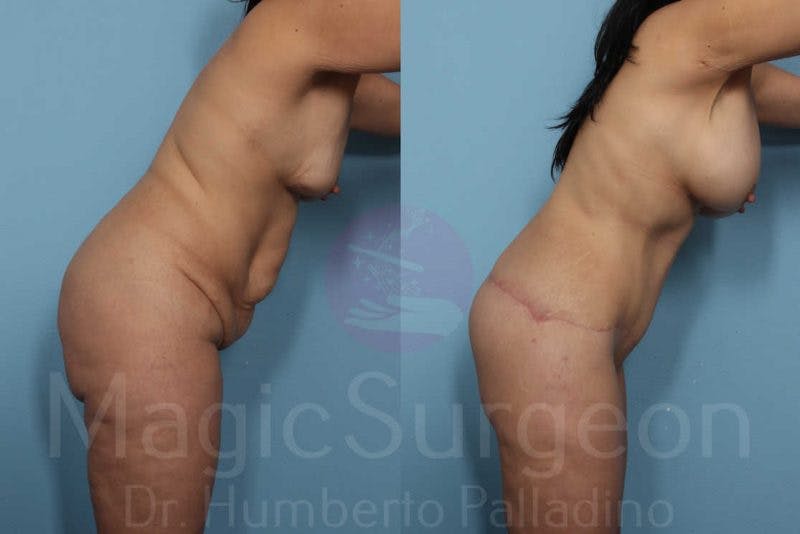Body Contouring Before & After Gallery - Patient 133182301 - Image 7