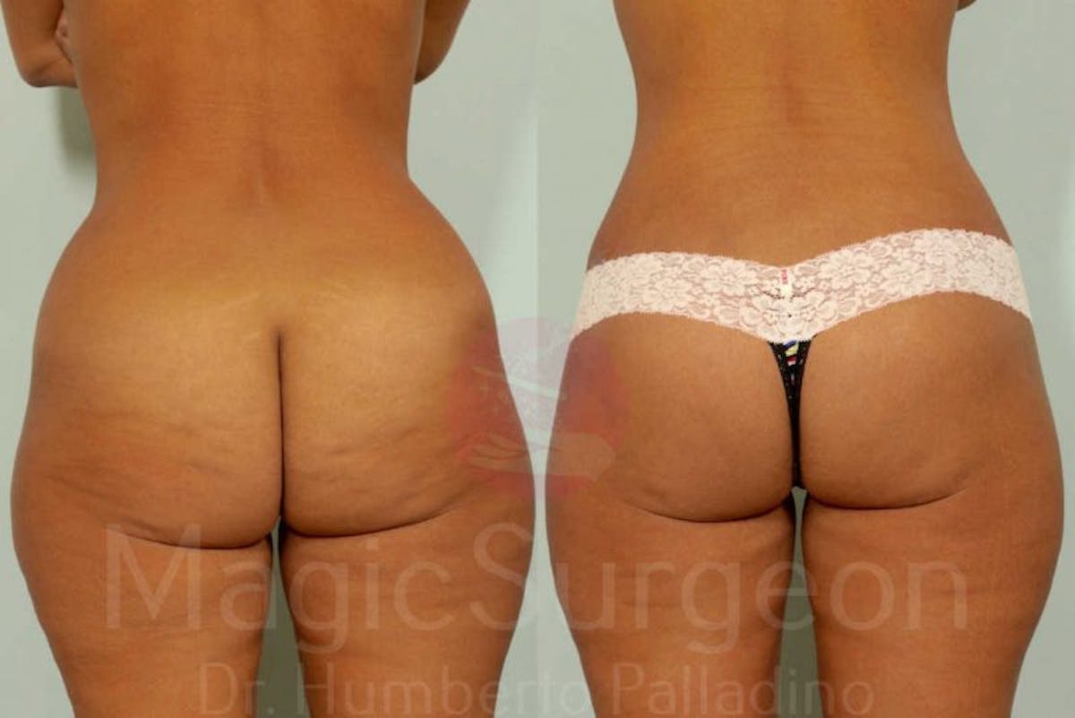 Brazilian Butt Lift Before & After Gallery - Patient 143542140 - Image 1