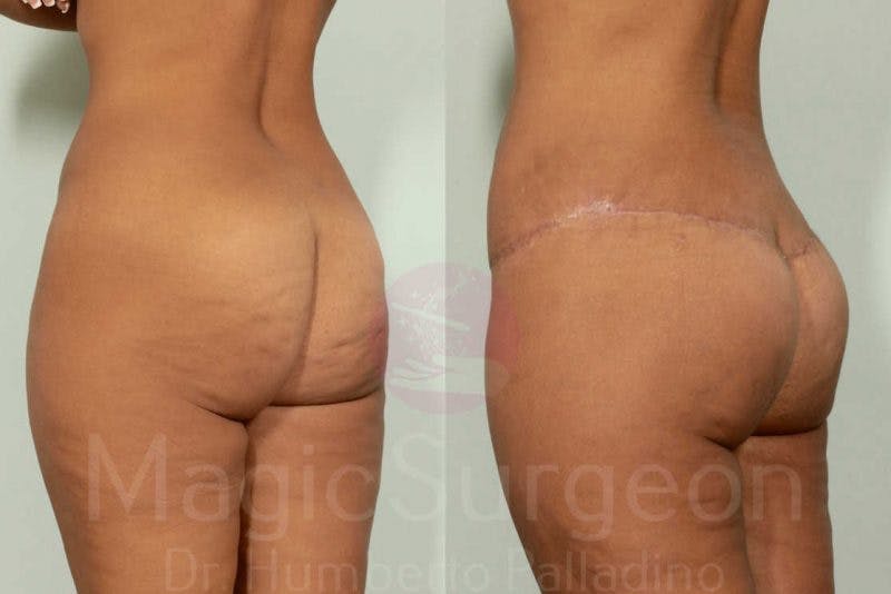 Brazilian Butt Lift Before & After Gallery - Patient 143542140 - Image 5