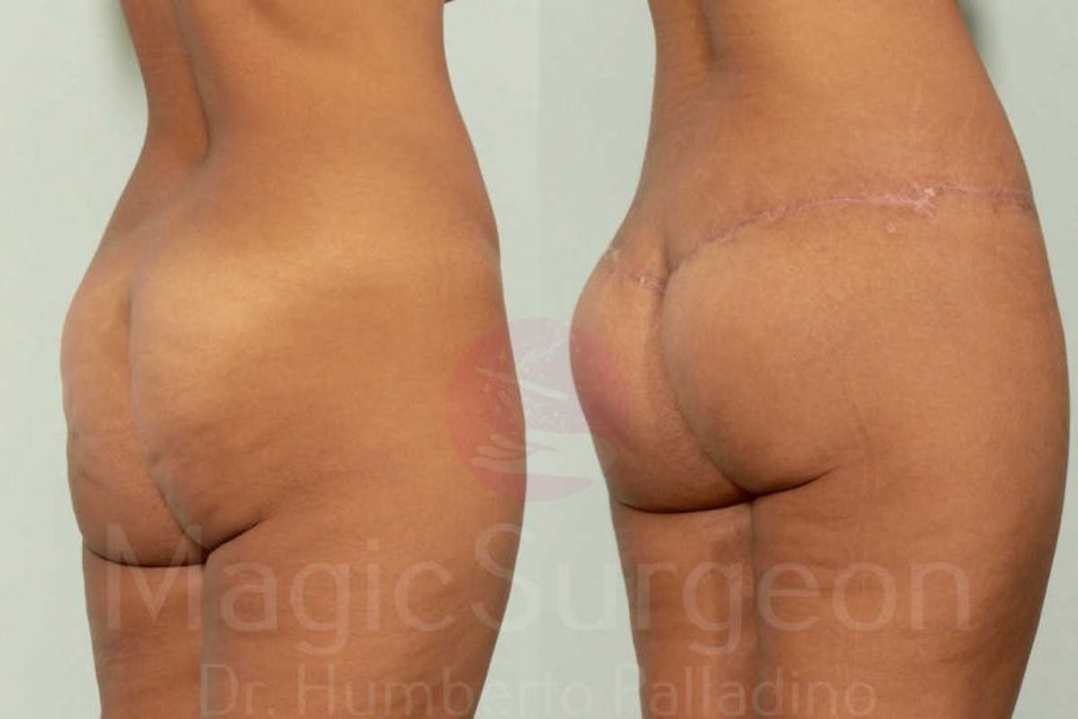 Brazilian Butt Lift Before & After Gallery - Patient 143542140 - Image 3