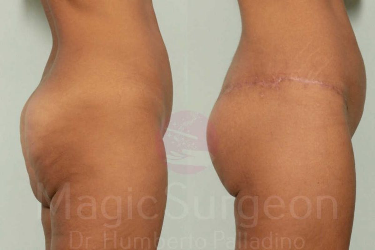 Brazilian Butt Lift Before & After Gallery - Patient 143542140 - Image 2