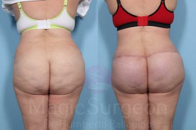 Brazilian Butt Lift Before & After Gallery - Patient 143542470 - Image 1