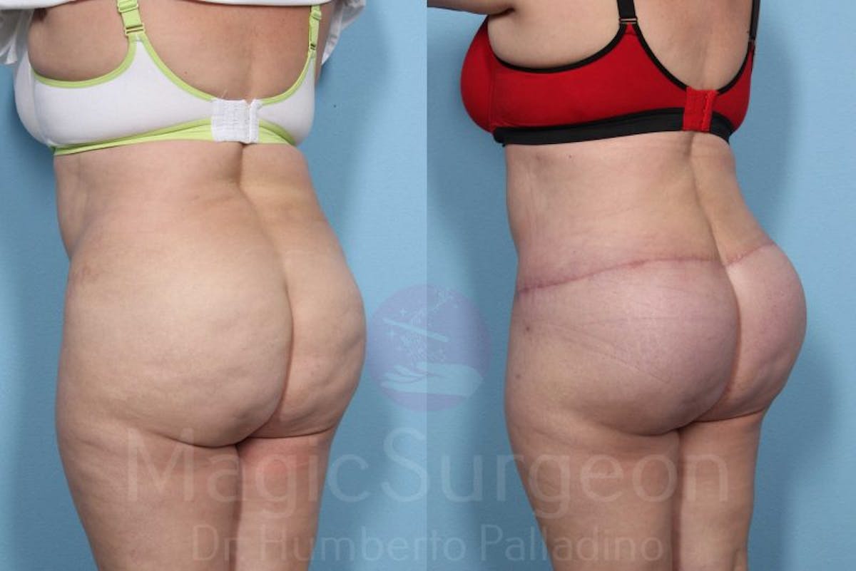 Brazilian Butt Lift Before & After Gallery - Patient 143542470 - Image 5