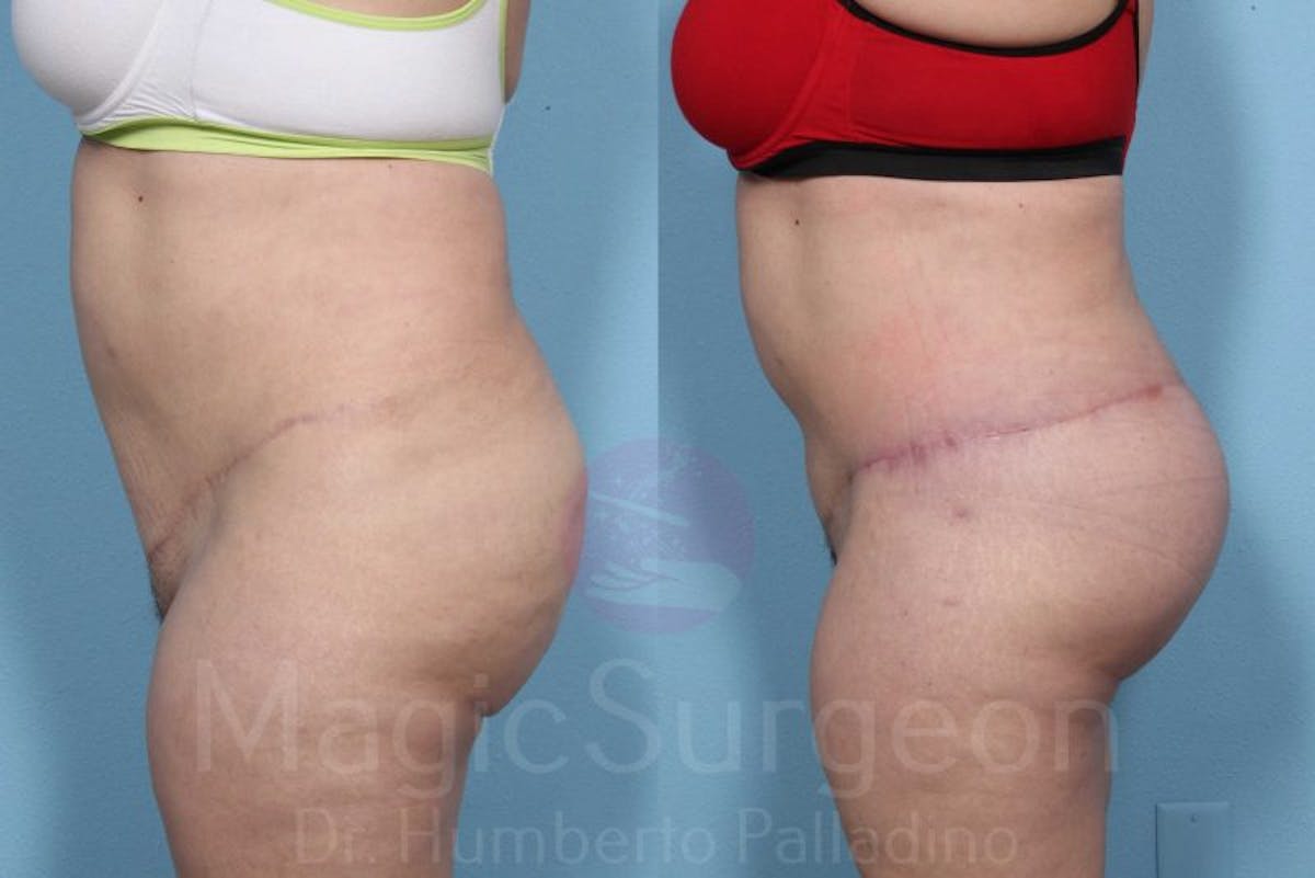 Brazilian Butt Lift Before & After Gallery - Patient 143542470 - Image 4