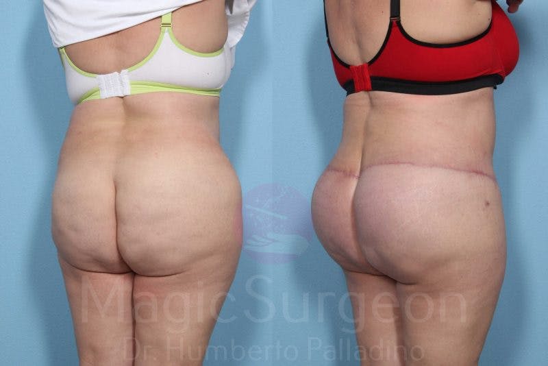 Brazilian Butt Lift Before & After Gallery - Patient 143542470 - Image 3