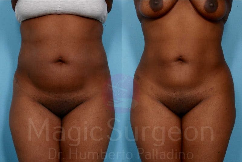Liposuction Before & After Gallery - Patient 133182306 - Image 1
