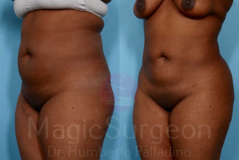Liposuction Before & After Gallery - Patient 133182306 - Image 2