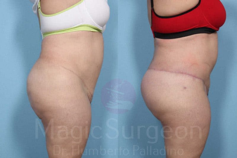 Brazilian Butt Lift Before & After Gallery - Patient 143542470 - Image 2